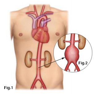 L'anévrisme de l'aorte Tunisie - 1