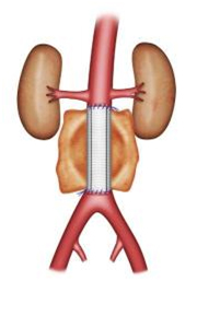 L'anévrisme de l'aorte 9