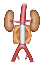 L'anévrisme de l'aorte 9