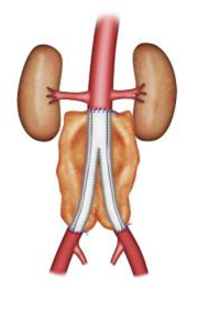 L'anévrisme de l'aorte 7