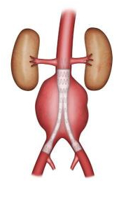 L'anévrisme de l'aorte 6