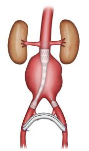 L'anévrisme de l'aorte Tunisie