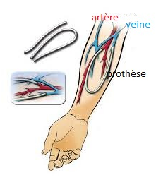 Fistule Artério-Veineuse Prothétique