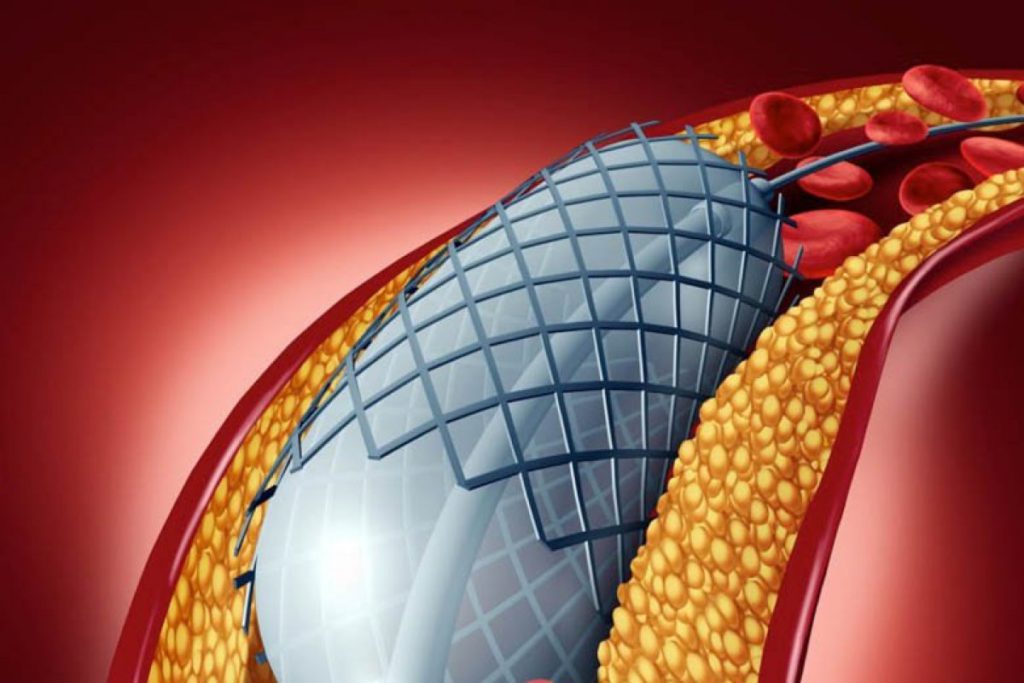 Endoprothèse aortique Chirurgie Vasculaire Tunisie