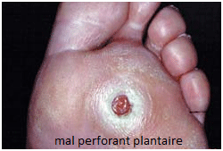 pied diab&eacute;tique