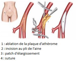 L'anévrisme de l'aorte 4