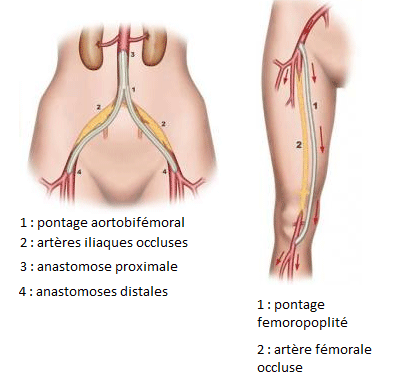 L'anévrisme de l'aorte 1
