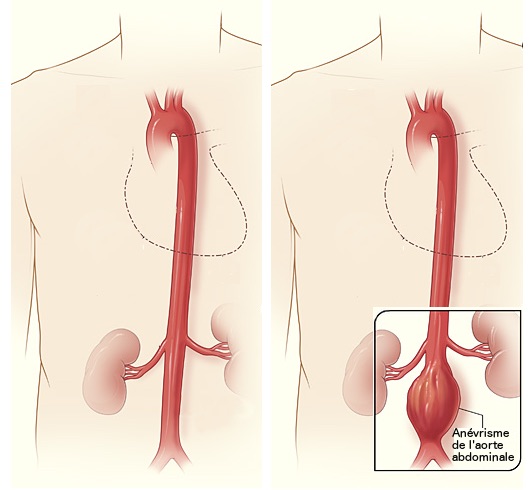 Comment lutter contre l’anévrisme de l’aorte abdominale ?