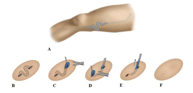 chirurgie des varices Tunisie