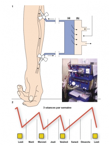 Proc&eacute;dure d&rsquo;H&eacute;modialyse