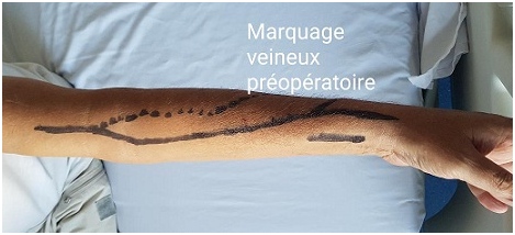 Fistule Art&eacute;rio-Veineuse