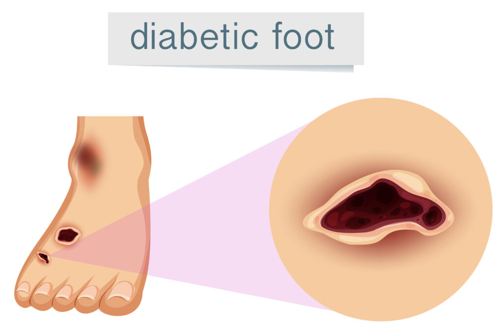 Comment éviter les ulcères du pied diabétique ? Conseils de prévention